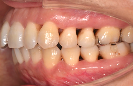 方 治し 歯肉 炎 歯肉退縮の６つの原因と自分でできる歯肉退縮の治し方
